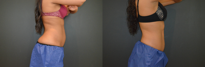 CoolSculpting before and after photo