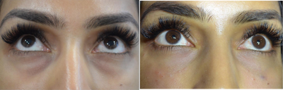 Eyelid Surgery before and after photo