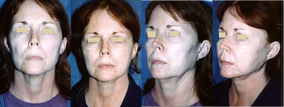 Facelift before and after photo