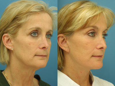 Facelift before and after photo