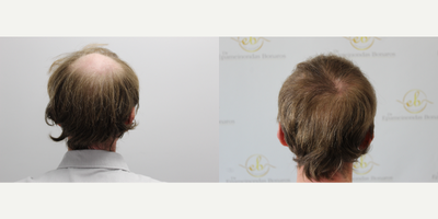 Hair Transplant before and after photo
