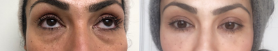 Restylane before and after photo