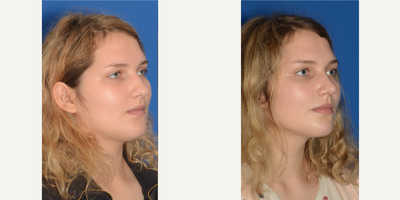 Rhinoplasty before and after photo