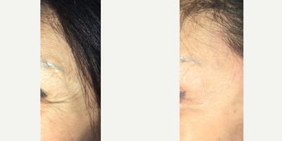 Botox before and after photo