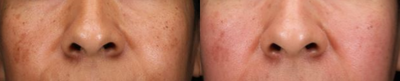 Chemical Peel before and after photo
