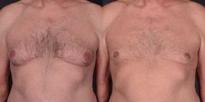 Gynecomastia Surgery before and after photo