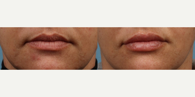Lip Fillers before and after photo