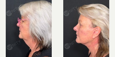 Lip Lift before and after photo