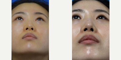 Asian Rhinoplasty before and after photo
