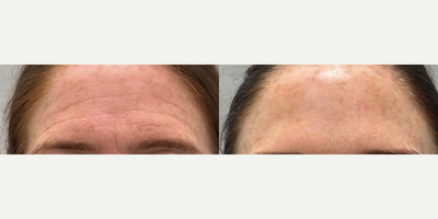 Botox before and after photo