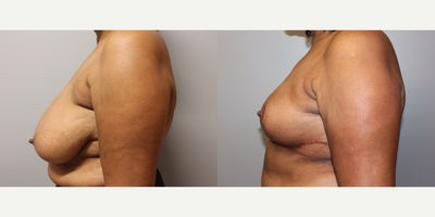 Breast Reduction before and after photo