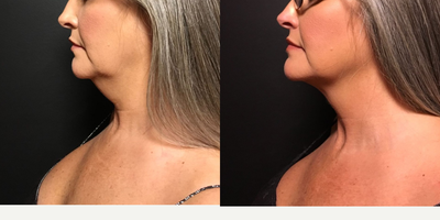 CoolSculpting before and after photo