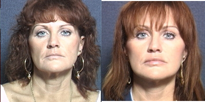 Facelift before and after photo