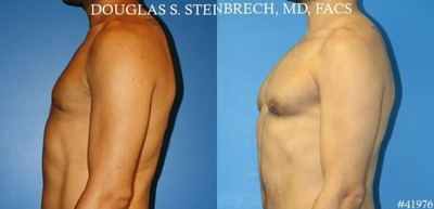 Pec Implants before and after photo