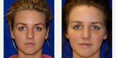 Rhinoplasty before and after photo