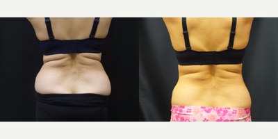 SculpSure before and after photo