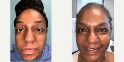 Thread Lift before and after photo
