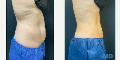 BodyTite before and after photo