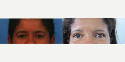 Eyelid Surgery before and after photo