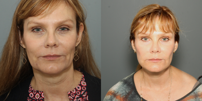 Facelift before and after photo