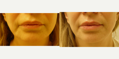 Lip Fillers before and after photo