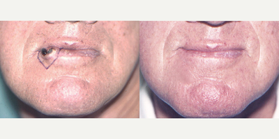 Lip Surgery before and after photo