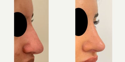 Revision Rhinoplasty before and after photo