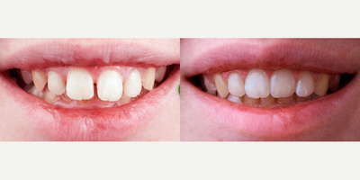 Smile Makeover before and after photo