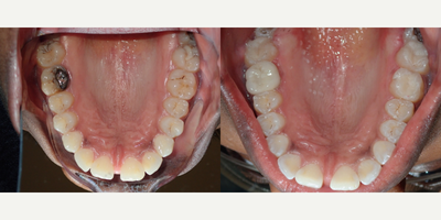 Tooth Repair before and after photo