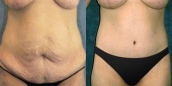 Tummy Tuck before and after photo