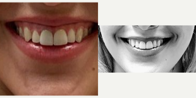 Botox before and after photo