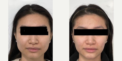 Botox before and after photo