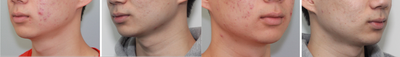 Buccal Fat Removal before and after photo