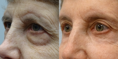CO2 Laser before and after photo