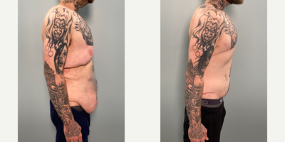 Male Tummy Tuck before and after photo