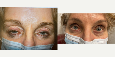 Ptosis Surgery before and after photo