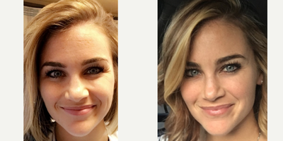 Botox before and after photo