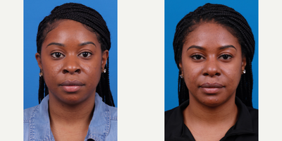 Chin Implant before and after photo