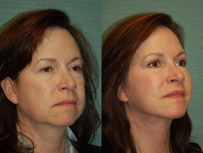 Facelift before and after photo