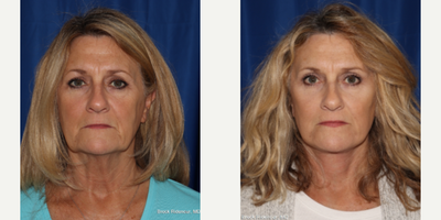 Facelift before and after photo