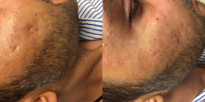 Microneedling before and after photo