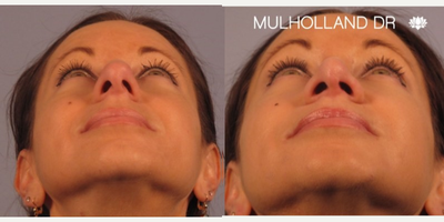 Rhinoplasty before and after photo