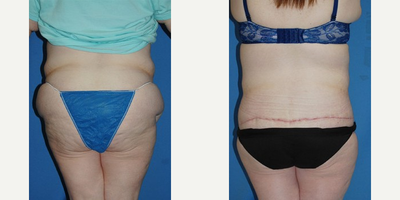 Body Lift before and after photo