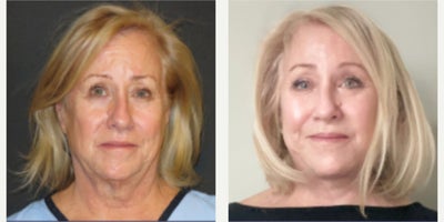 Deep Plane Facelift before and after photo