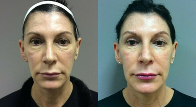 Juvederm before and after photo