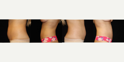 Liposuction before and after photo
