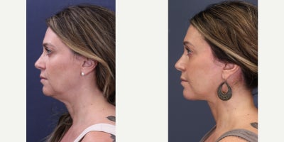 Deep Plane Facelift before and after photo