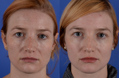 Fractora RF before and after photo