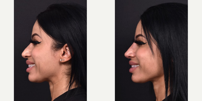 Nonsurgical Nose Job before and after photo