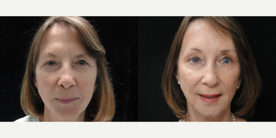 Brow Lift before and after photo